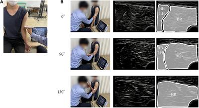 Brachialis Muscle Activity Can Be Measured With Surface Electromyography: A Comparative Study Using Surface and Fine-Wire Electrodes